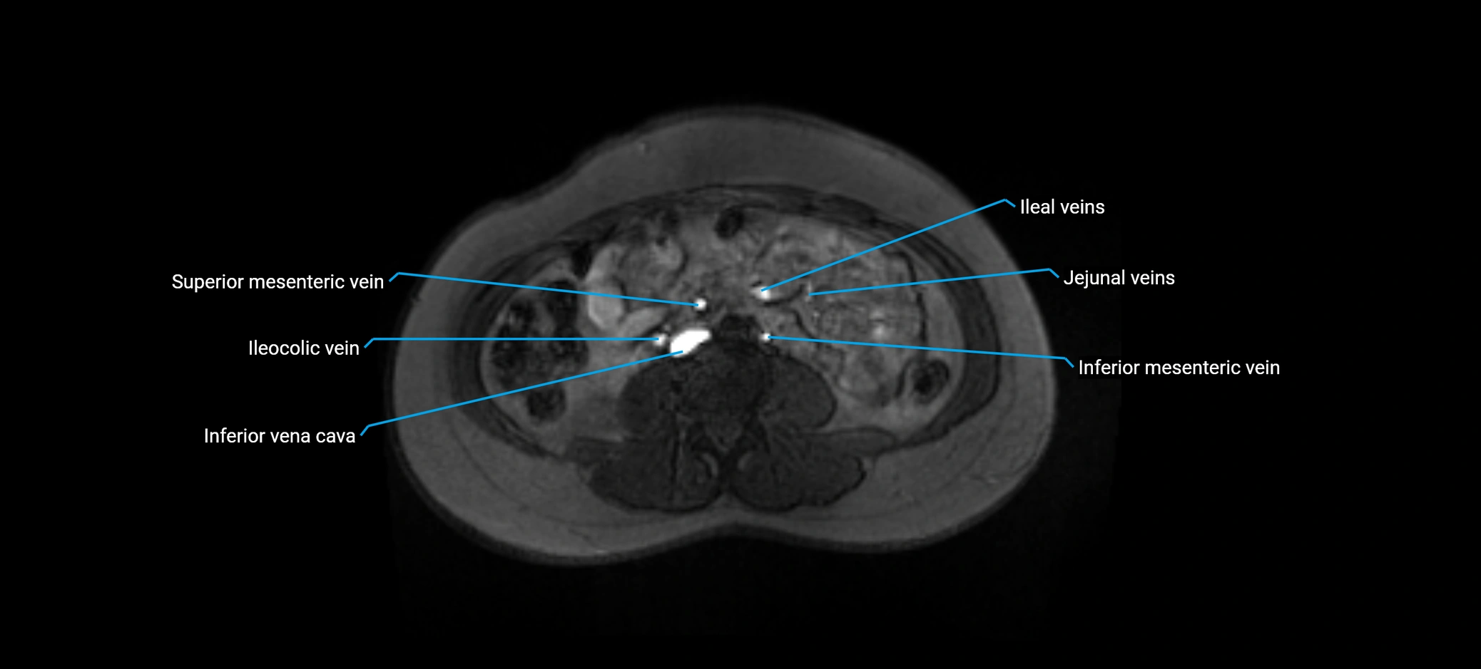 MRV abdomen pelvis & lower limb axial cross sectional anatomy labelled MRI image 101 (1).webp